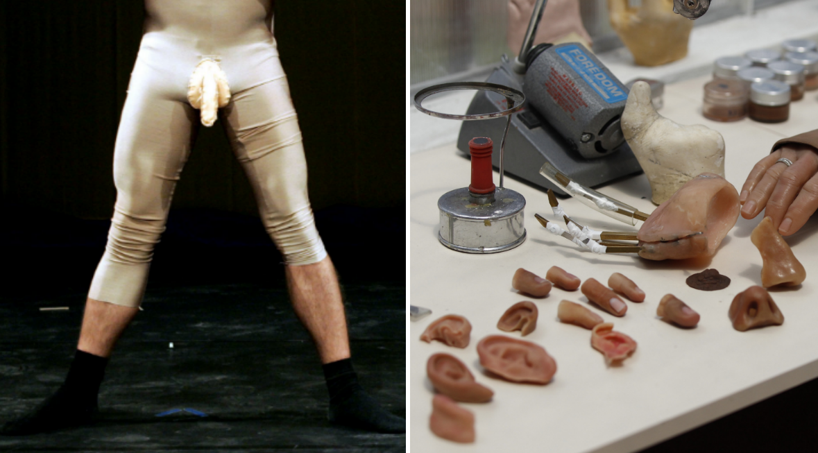 Penis, Operation, Penisprotes, Ingrepp, Lakare, Rättegång